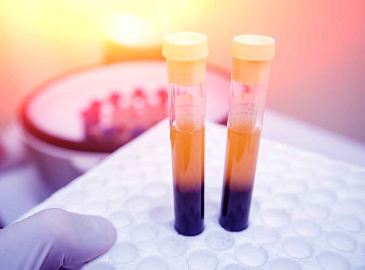 photo of a test tube with blood plasma