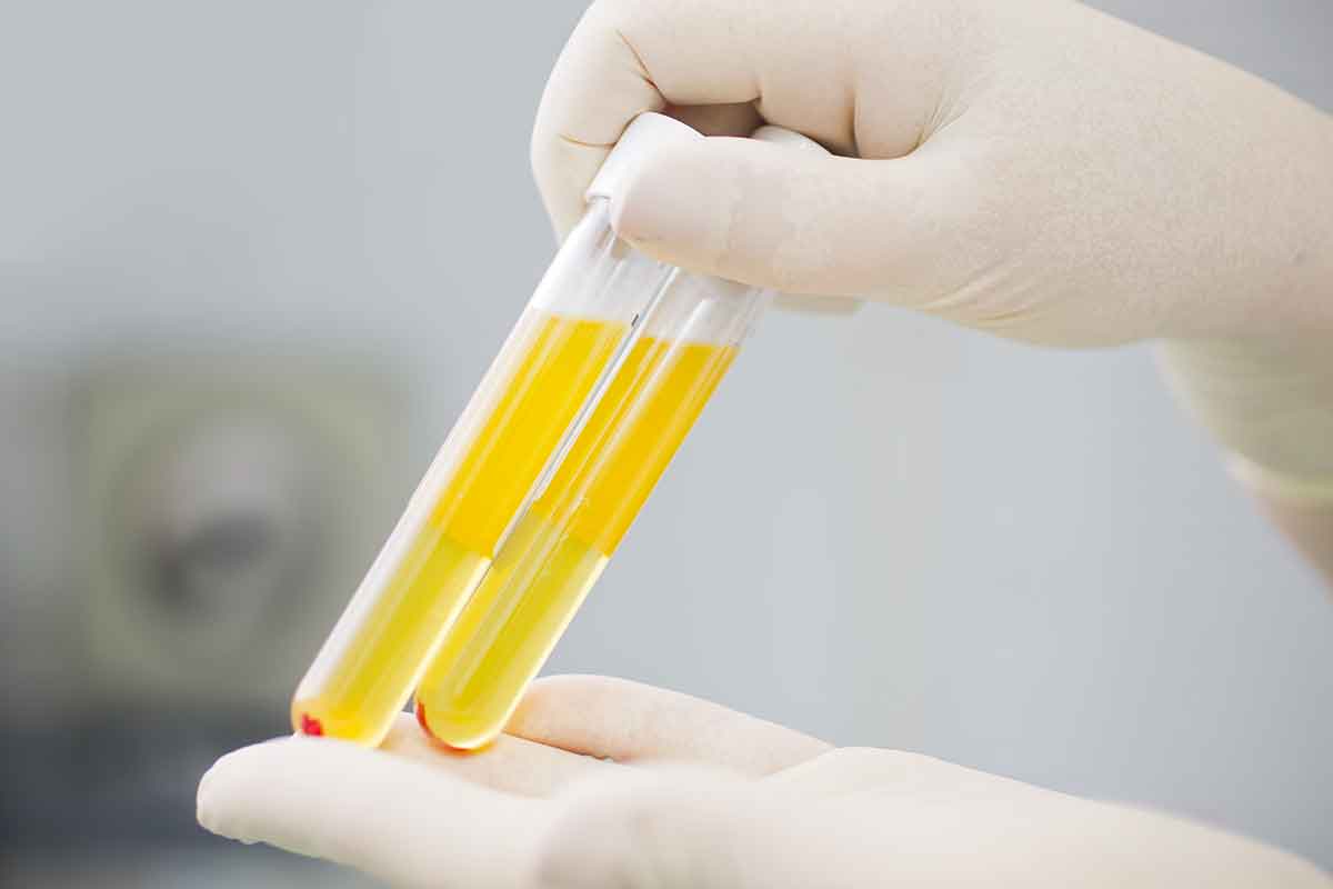 photo of a test tube with blood serum